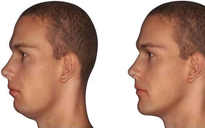 پروتز همزمان چانه و گونه