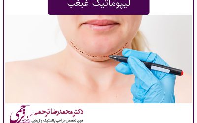 همه چیز درباره لیپوماتیک غبغب