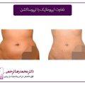 تفاوت-بین-لیپوماتیک-و-لیپوساکشن